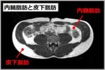 内臓脂肪と皮下脂肪の断面図