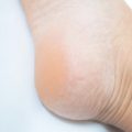 かかとのガサガサが治らないのは水虫が原因かも