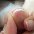 転倒しやすくなる原因は足の親指の巻き爪だった