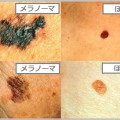 メラノーマの写真を見ながら見分け方をチェック