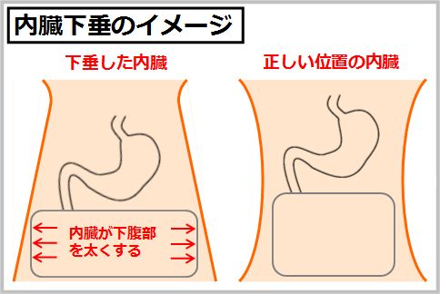 お腹の肉の原因は皮下脂肪と内臓脂肪と内臓下垂
